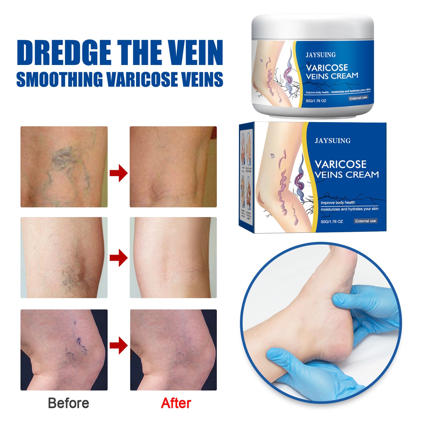 Leg Vein Repair Cream Varicose Massage